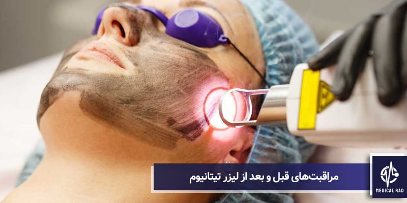 مراقبت‌های قبل و بعد از لیزر تیتانیوم